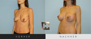 Brustvergrößerung Vorher Nachher Bilder Patient 017