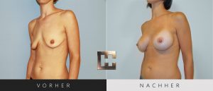 Brustvergrößerung Vorher Nachher Bilder Patient 018