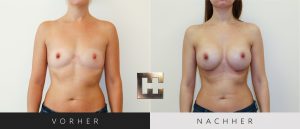 Brustvergrößerung Vorher Nachher Bilder Patient 019