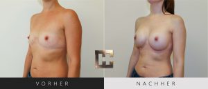 Brustvergrößerung Vorher Nachher Bilder Patient 019