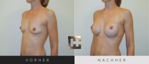 Brustvergrößerung Vorher Nachher Bilder Patient 021