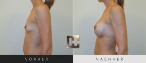Brustvergrößerung Vorher Nachher Bilder Patient 021