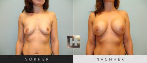 Brustvergrößerung Vorher Nachher Bilder Patient 030