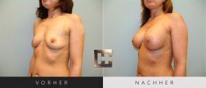 Brustvergrößerung Vorher Nachher Bilder Patient 030