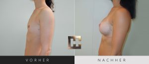 Brustvergrößerung Vorher Nachher Bilder Patient 038