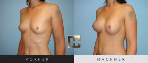 Brustvergrößerung Vorher Nachher Bilder Patient 040