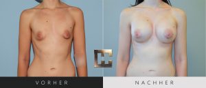 Brustvergrößerung Vorher Nachher Bilder Patient 045