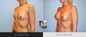 Brustvergrößerung Vorher Nachher Bilder Patient 047