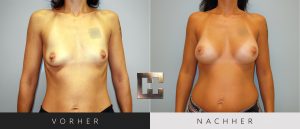 Brustvergrößerung Vorher Nachher Bilder Patient 048