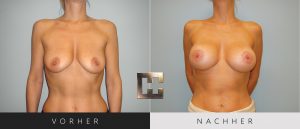 Brustvergrößerung Vorher Nachher Bilder Patient 052