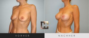 Brustvergrößerung Vorher Nachher Bilder Patient 052
