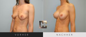 Brustvergrößerung Vorher Nachher Bilder Patient 053