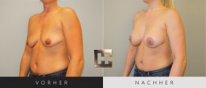 Brustvergrößerung Vorher Nachher Bilder Patient 055