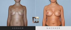 Brustvergrößerung Vorher Nachher Bilder Patient 062