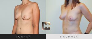 Pjure Breast Vorher Nachher Bilder Patient 066