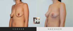 Pjure Breast Vorher Nachher Bilder Patient 067