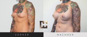 Pjure Breast Composite Vorher Nachher Bilder Patient 201